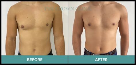 gynecomastia melbourne fl|Gynecomastia – Reguve Foundation.